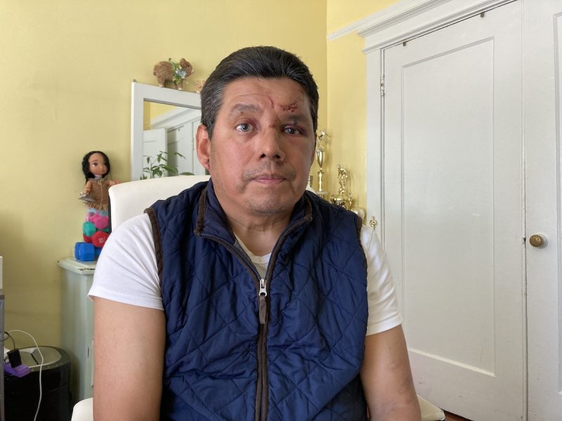 A man dressed in a t-shirt and a vest has stitches in his forehead and ear, and bruises on his face