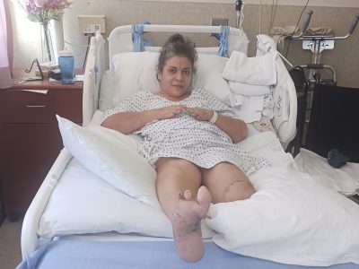 Carmen Marquez on her bed at San Francisco General Hospital, showing missing toes from meningitis. Photo courtesy of Carmen Marquez.