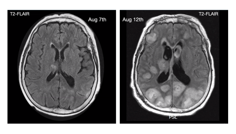 Two brain MRI scans labeled T2-FLAIR, dated August 7th and August 12th, showing changes in brain structure between the two dates for research purposes.