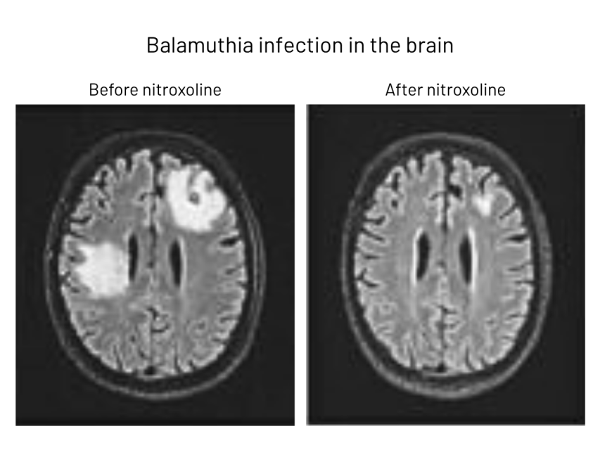 Side-by-side brain MRIs show a large white area before nitroxoline treatment and reduced white area after treatment for Balamuthia infection.