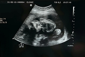 Black and white ultrasound image showing the side view of a developing fetus inside the womb. Medical data and measurements are visible along the edges of the image.
